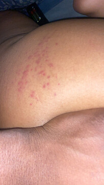 This is a rash on her butt 